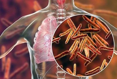 Tuberculosis :: UP को टीबी से मुक्ति का चल रहा अभियान 24 मार्च तक, 27 लाख से अधिक की हो चुकी है स्क्रीनिंग